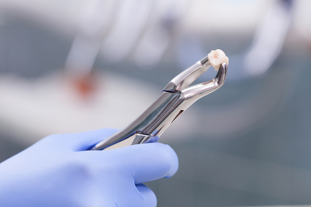 Tooth extraction recovery timeline showing normal healing progression at Caledon Dental Centre